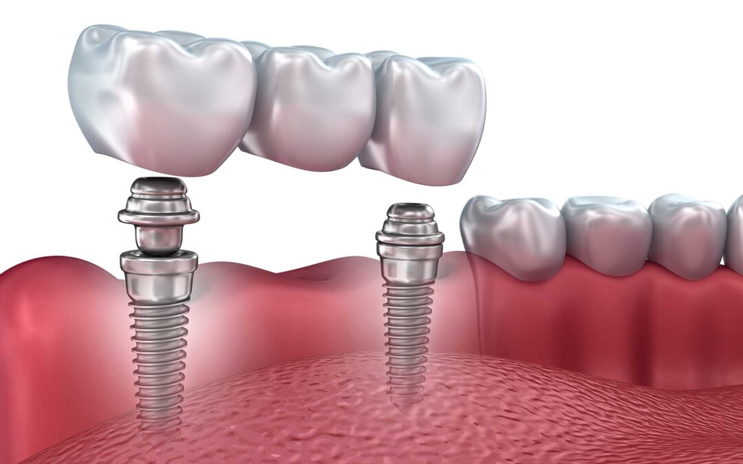 HOW MUCH DO ALL-ON-X DENTAL IMPLANTS COST?