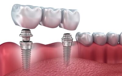 HOW MUCH DO ALL-ON-X DENTAL IMPLANTS COST?