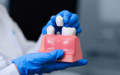Everything You Need to Know About Dental Implants: A Complete Guide