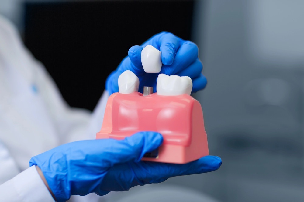 Everything You Need to Know About Dental Implants: A Complete Guide