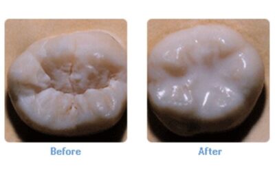 Dental Sealants: Protect Your Teeth from Cavities with This Simple Solution
