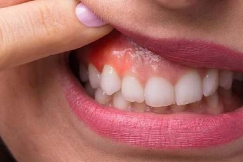 Treatment of Infected Gums
