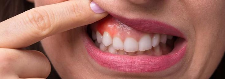 Gum Disease Treatment Near Me: Restore Your Oral Health Today