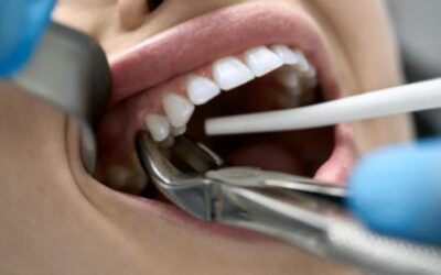 Blog 3 Dental Extractions Near Me: What to Expect and How to Prepare