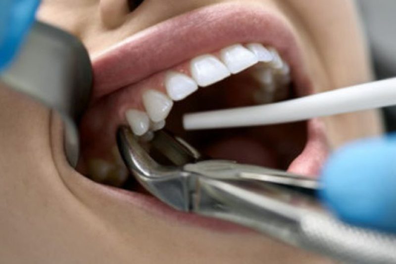 When Should I Get A Tooth Extraction