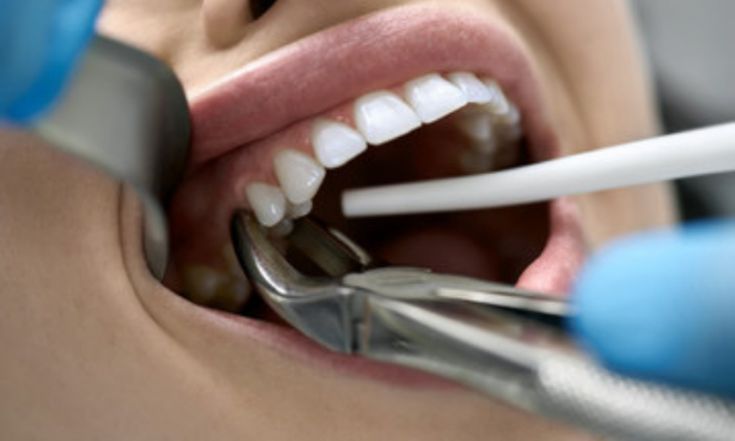 Dental Extractions Near Me: What to Expect and How to Prepare
