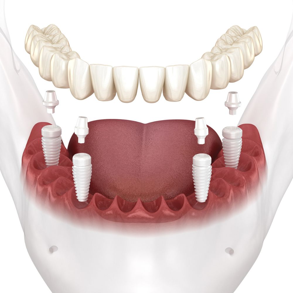 Full Mouth Reconstruction In Tampa FL
