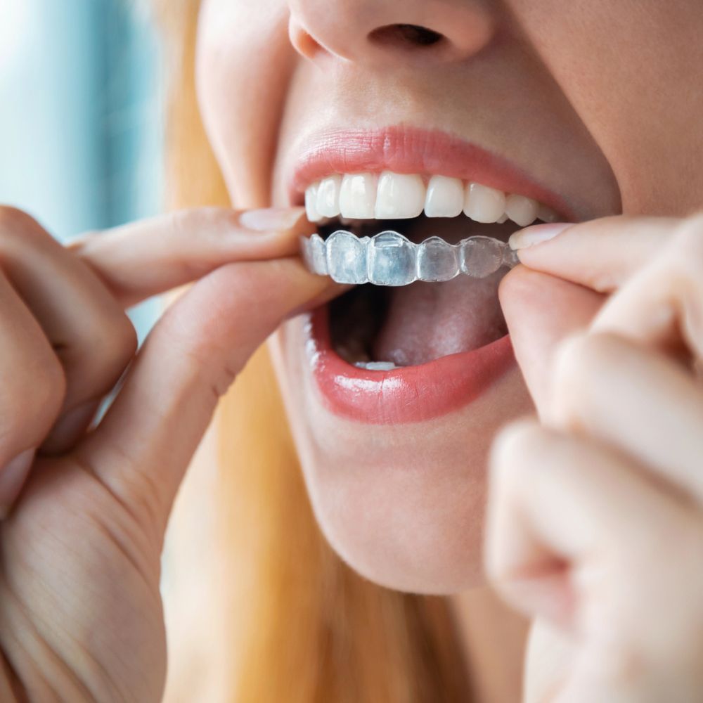 Invisalign Clear Aligners In Tampa FL