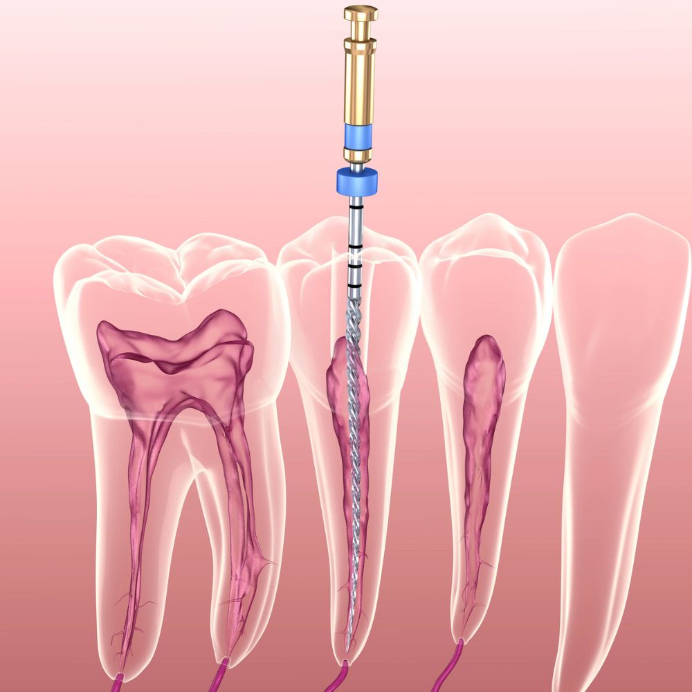 Root Canal Therapy In Tampa FL