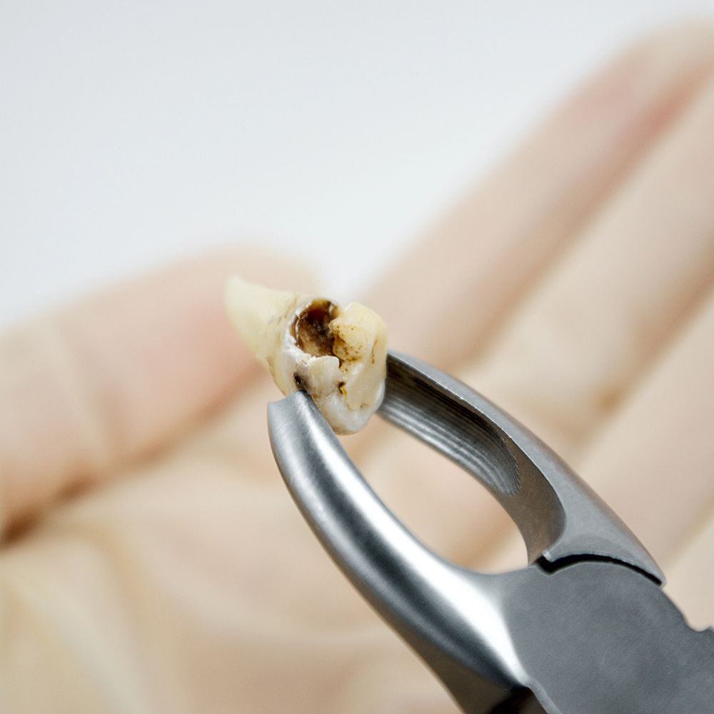 Wisdom teeth extraction In Tampa FL