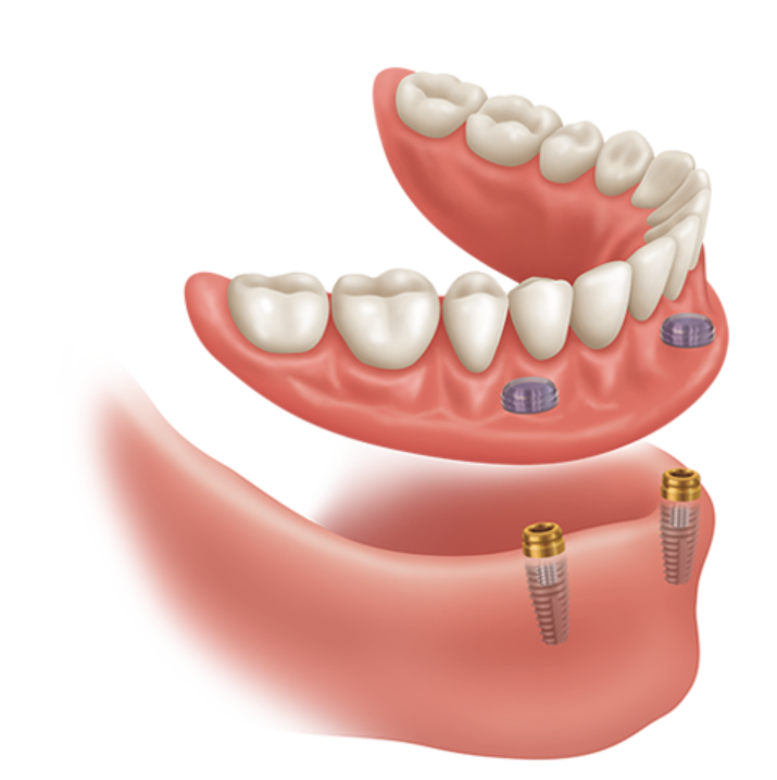 Dental Implants In Tampa FL